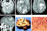 Najít lék na onemocnění PAM se dlouhá léta snažili vědci z celého světa. Na snímku: Ukázky devastujícího vlivu onemocnění PAM na lidský mozek u 14leté dívky.