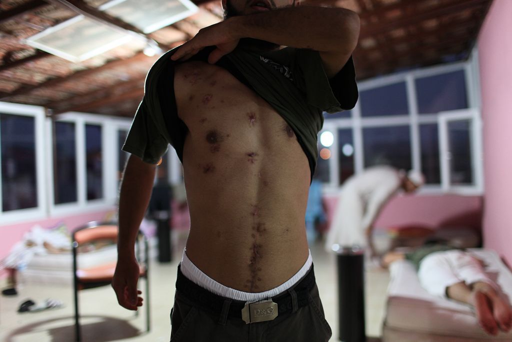 Foto: Člověk v tísni - Léčba zraněných Syřanů v Turecku