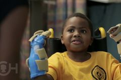Lékaři transplantovali osmiletému chlapci obě ruce