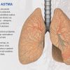 Astma 1