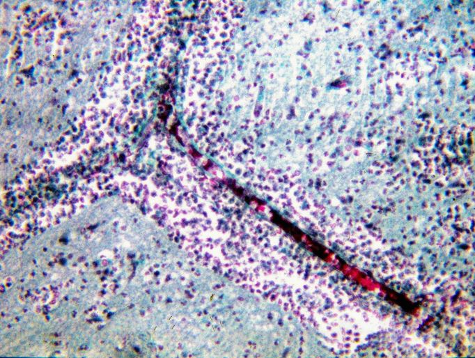 Histologický preparát tkáně mozku jedné z obětí PAME v Ústí:
podélný řez kapilárou s prosáklým perivaskulárním prostorem naplněným
amébami a bílými krvinkami.