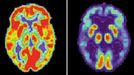 Snímek zobrazuje zdravý mozek (nalevo) a mozek napadený Alzheimerovou chorobou.