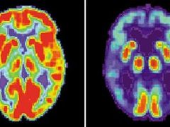 Snímek zobrazuje zdravý mozek (nalevo) a mozek napadený Alzheimerovou chorobou.