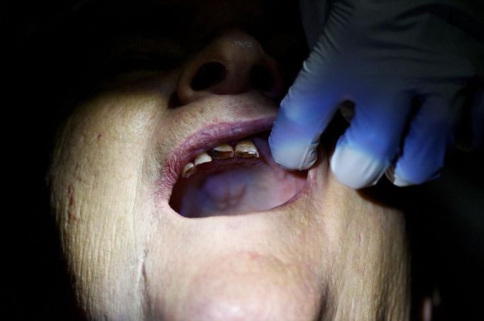 A dentist prepares to extract teeth at the Remote Area Medical clinic in Wise, Virginia July 20, 2012. RAM clinics bring free medical, dental and vision care to uninsured and under-insured people across the country and abroad. The Wise clinic was the 647th RAM expedition since 1985 and drew 1700 patients from 14 states, organizers said. Picture taken July 20, 2012. REUTERS/Mark Makela (UNITED STATES - Tags: HEALTH SOCIETY) Published: Čec. 24, 2012, 3:09 odp.