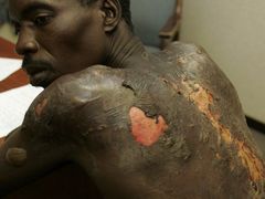 Přívrženec MDC ukazuje popáleniny, které mu způsobili stoupenci prezidenta Mugabeho