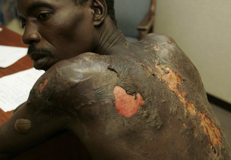 Přívrženec MDC ukazuje popáleniny