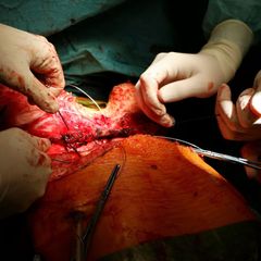 Uzavírání operačního pole v hrudníku příjemce