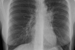 Tuberkulóza má do 40 let zmizet, leč v Česku jí přibývá