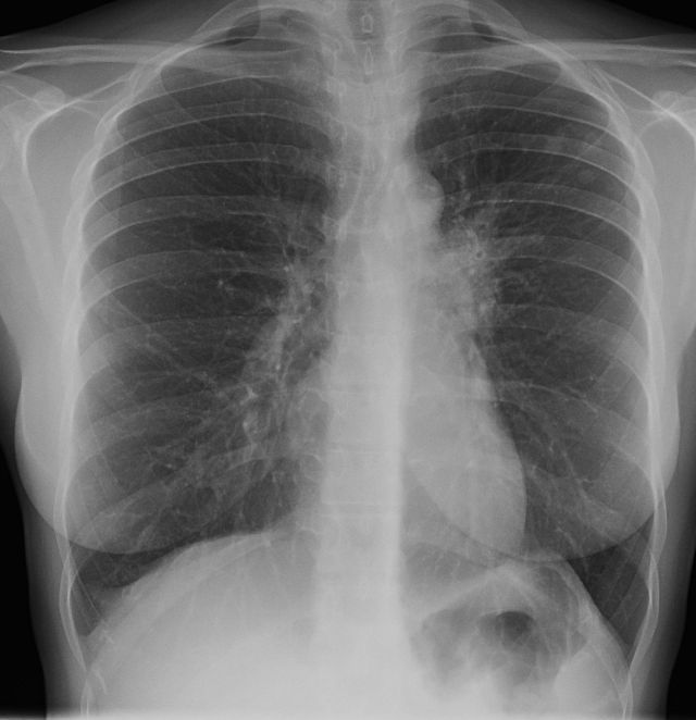 Plíce Tuberkulóza