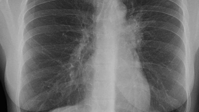 Plíce s tuberkulózou. Všichni běženci v záchytných zařízeních procházejí komplexní zdravotní kontrolou, která zahrnuje i rentgen plic. (ilustrační foto)