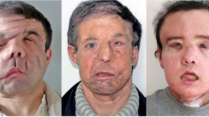 Francouz Jérôme Hamon se stal prvním člověkem na světě, který má za sebou dvojí transplantaci obličeje.