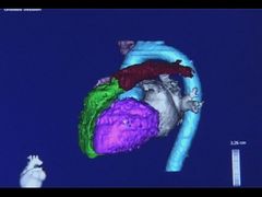 Snížením cholesterolu se podaří zachránit řadu životů ohrožených srdečními záchvaty. Výhody léků převyšují potencionální nevýhody a rizika.