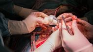Motol kardiovaskulární chirurgie operace aorty