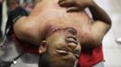 A man with a gunshot wound to his neck reacts while lying on a stretcher at the emergency ward of a local hospital in San Pedro Sula March 20, 2013. San Pedro Sula, the country's second largest city after Tegucigalpa, has a homicide rate of 169 per 100,000 people and was named the world's most violent city for a second year in a row. Lax laws allow civilians to own up to five personal guns. Arms trafficking has flooded the country with nearly 70% illegal firearms. 83.4% of homicides are by firearms, compared to 60% in the United States. Picture taken March 20, 2013. REUTERS/Jorge Cabrera (HONDURAS - Tags: CRIME LAW CIVIL UNREST HEALTH) ATTENTION EDITORS: PICTURE 23 OF 39 FOR PACKAGE 'GUN CULTURE - HONDURAS' SEARCH 'HONDURAS GUN' FOR ALL IMAGES Published: Dub. 5, 2013, 11:15 dop.