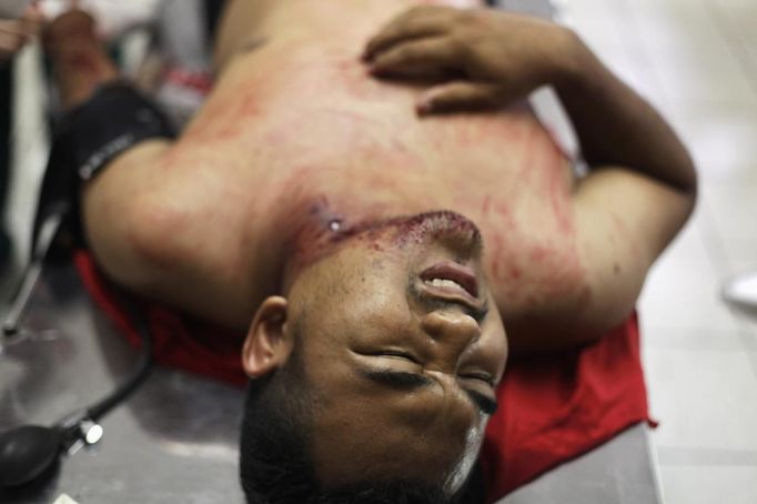 A man with a gunshot wound to his neck reacts while lying on a stretcher at the emergency ward of a local hospital in San Pedro Sula March 20, 2013. San Pedro Sula, the country's second largest city after Tegucigalpa, has a homicide rate of 169 per 100,000 people and was named the world's most violent city for a second year in a row. Lax laws allow civilians to own up to five personal guns. Arms trafficking has flooded the country with nearly 70% illegal firearms. 83.4% of homicides are by firearms, compared to 60% in the United States. Picture taken March 20, 2013. REUTERS/Jorge Cabrera (HONDURAS - Tags: CRIME LAW CIVIL UNREST HEALTH) ATTENTION EDITORS: PICTURE 23 OF 39 FOR PACKAGE 'GUN CULTURE - HONDURAS' SEARCH 'HONDURAS GUN' FOR ALL IMAGES Published: Dub. 5, 2013, 11:15 dop.