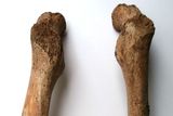 Asymetrie dívčiny levé a pravé stehenní kosti, kvůli které pravděpodobně kulhala.