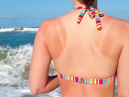 Spálení od sluníčka neberte na lehkou váhu, je tu pak větší riziko rakoviny kůže