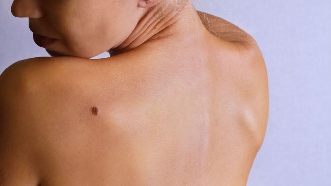 První příznaky - rakovina kůže