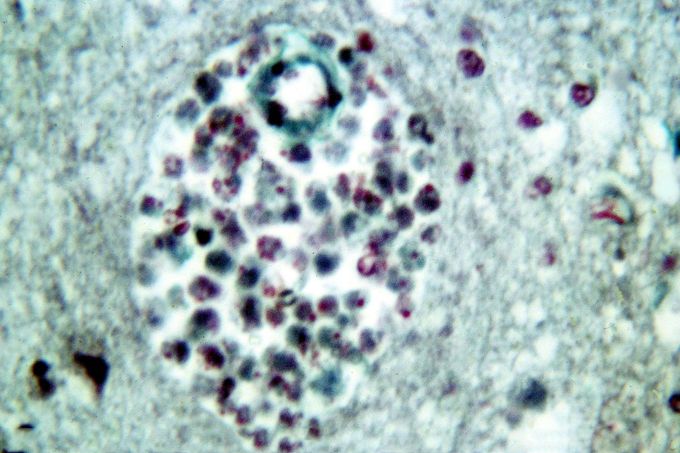 Příčný řez kapilárou ukazující zduřelý perivaskulární prostor plný namnožených mikrobů Naegleria fowleri. Mikroskopický snímek vzorku mozku jedné z obětí.