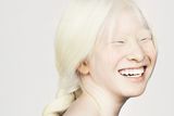 Brock Elbank: Xueli, Londýn. Fotograf portrétoval albínskou dívku Xueli, která se narodila v Číně a adoptovala ji rodina v Nizozemsku. Čtrnáctiletá dívka velmi špatně vidí a její oči extrémně trpí v ostrém světle.