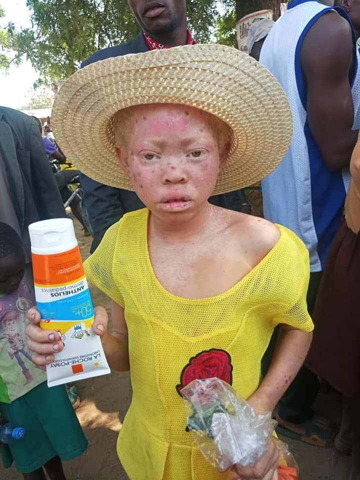 Ghana albíni