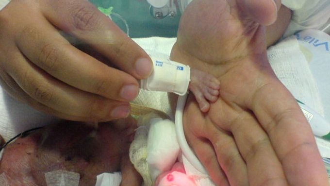 Holčička narozená v Brazílii měřila po porodu jen 27 centimetrů. Na snímku její nožička v dlani lékaře.