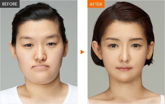 Plastické operace v Jižní Korey