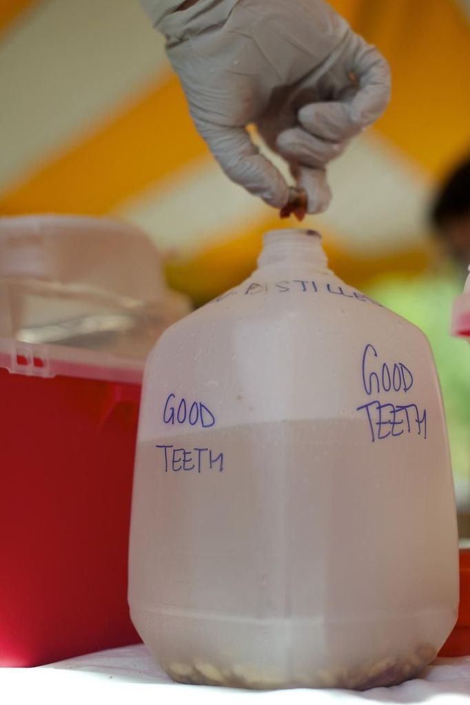 A dentist drops extracted teeth in a gallon jug of distilled water at the Remote Area Medical (RAM) clinic in Wise, Virginia July 20, 2012. RAM clinics bring free medical, dental and vision care to uninsured and under-insured people across the country and abroad. The Wise clinic was the 647th RAM expedition since 1985 and drew 1700 patients from 14 states, organizers said. Picture taken July 20, 2012. REUTERS/Mark Makela (UNITED STATES - Tags: HEALTH SOCIETY) Published: Čec. 24, 2012, 3:12 odp.