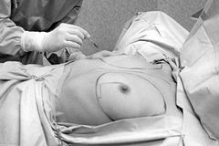 Parafín do ňader dnes děsí. Historické fotky ukazují první pokusy o zvětšení prsou