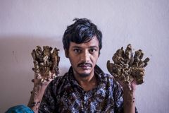 "Stromový muž" z Bangladéše už nesnese bolest rukou. Žádá o jejich amputaci