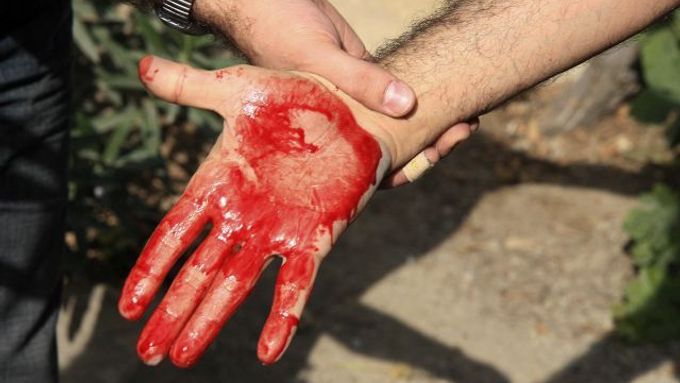 Zkrvavená ruka muže po sobotních protestech v Teheránu.