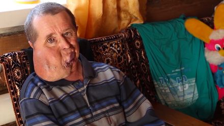 S nádorem na obličeji žije 45 let. Při životě ho drží jeho děti a práce