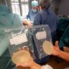Lékaři vyjímají defektní silikonové prsní implantáty společnosti PIP