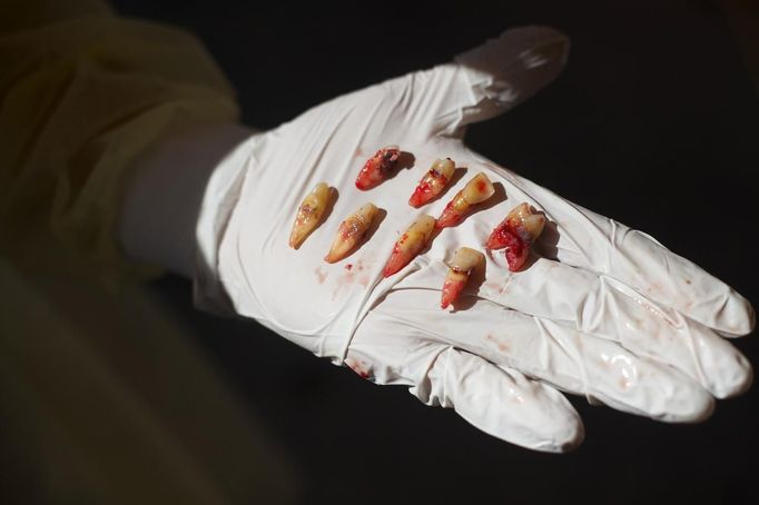 A dentist displays extracted teeth at the Remote Area Medical (RAM) in Wise, Virginia July 20, 2012. RAM clinics bring free medical, dental and vision care to uninsured and under-insured people across the country and abroad. The Wise clinic was the 647th RAM expedition since 1985 and drew 1700 patients from 14 states, organizers said. Picture taken July 20, 2012. REUTERS/Mark Makela (UNITED STATES - Tags: HEALTH SOCIETY) Published: Čec. 24, 2012, 3:11 odp.