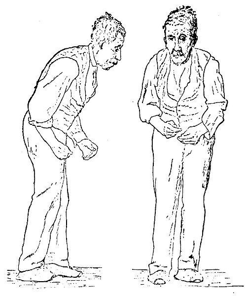 Člověk trpící Parkinsonovou nemocí - ilustrace z roku 1886