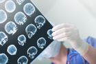 Mladý neurolog z Brna přišel na to, jak rychle odhalit mrtvici. Pozná ji i nezkušený lékař, říká