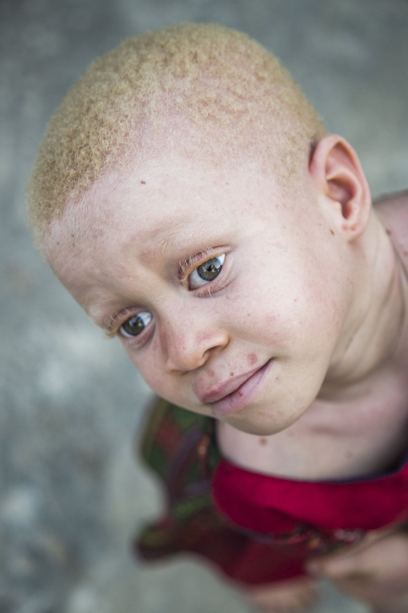 Ghana albíni