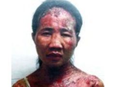 Siti Hajarová utrpěla zranění po celém těle. Její zaměstnavatelka ji týrala žehličkou, kladívkem a nůžkama