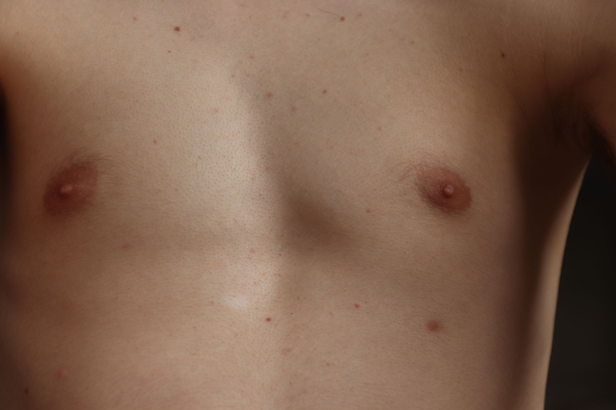 Mužská třetí bradavka