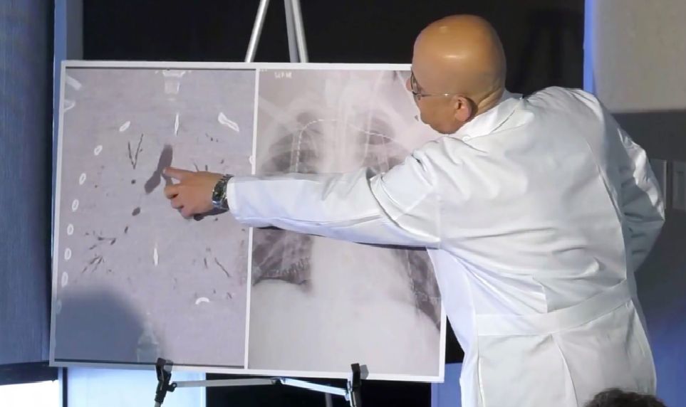 Rentgenové snímky plic chlapce, který podstoupil transplantaci (nalevo), a plic zdravého člověka