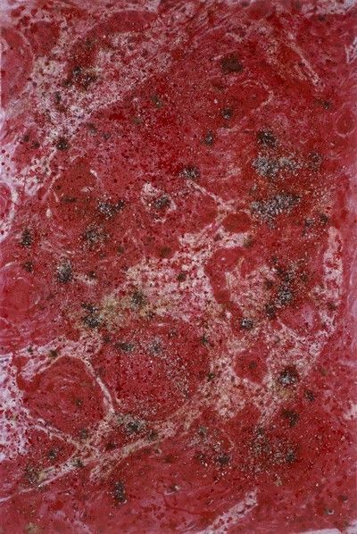 Damien Hirst: Skin cancer ...