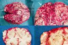 Ukázky devastujícího vlivu onemocnění PAM na lidský mozek. Na této koláži fotografií jsou vidět stopy po rozsáhlém krvácení a nekróze odumřelé mozkové tkáně.