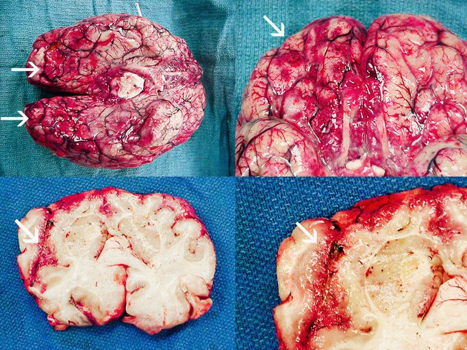 Ukázky devastujícího vlivu onemocnění PAM na lidský mozek. Na této koláži fotografií jsou vidět stopy po rozsáhlém krvácení a nekróze odumřelé mozkové tkáně.