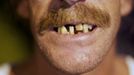 Joe Roberts, from Sutherland, Virginia, intending to have 10 teeth extracted, waits for his wristband number to be called at the Remote Area Medical (RAM) clinic in Wise, Virginia July 20, 2012. RAM clinics bring free medical, dental and vision care to uninsured and under-insured people across the country and abroad. The Wise clinic was the 647th RAM expedition since 1985 and drew 1700 patients from 14 states, organizers said. REUTERS/Mark Makela (UNITED STATES - Tags: HEALTH SOCIETY) Published: Čec. 24, 2012, 3:02 odp.