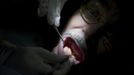 A dentist cleans a patients teeth at the Remote Area Medical (RAM) clinic in Wise, Virginia July 20, 2012. RAM clinics bring free medical, dental and vision care to uninsured and under-insured people across the country and abroad. The Wise clinic was the 647th RAM expedition since 1985 and drew 1700 patients from 14 states, organizers said. Picture taken July 20, 2012. REUTERS/Mark Makela (UNITED STATES - Tags: HEALTH SOCIETY) Published: Čec. 24, 2012, 3:07 odp.