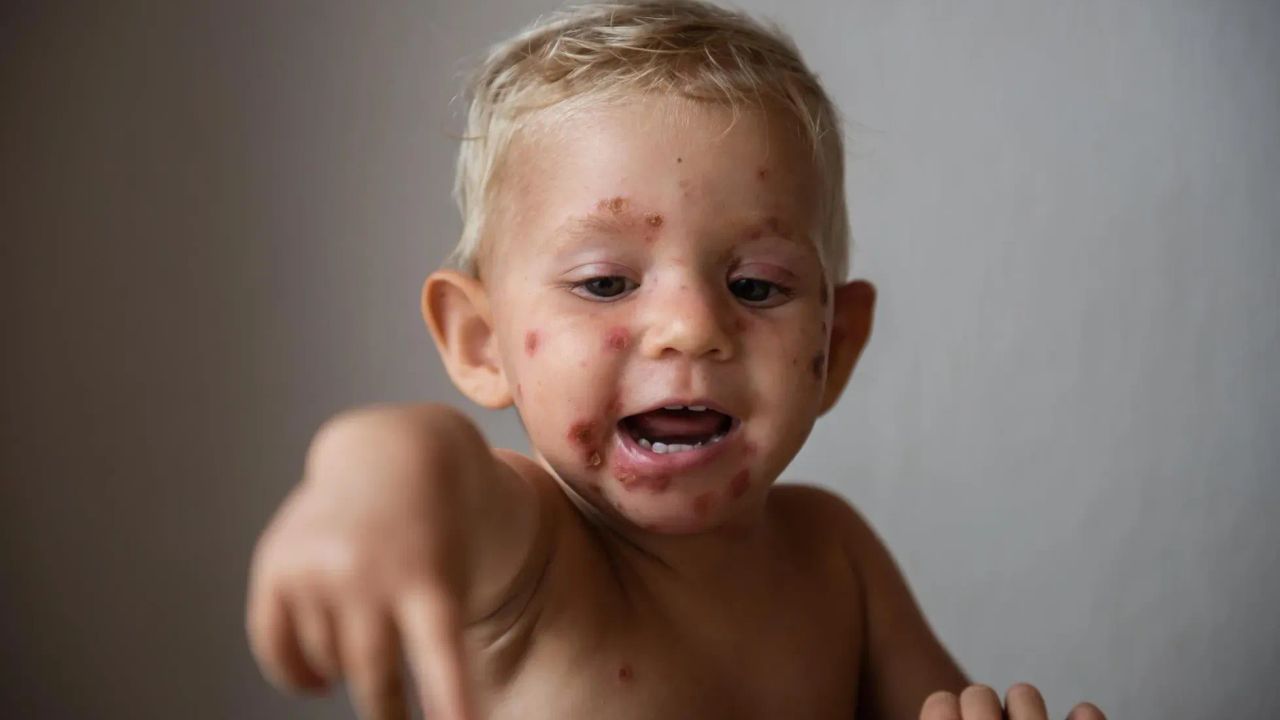 Impetigo se mezi dětmi šíří rychlostí blesku. Jak ho poznat a kdy jít k lékaři?