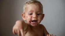 Impetigo se mezi dětmi šíří rychlostí blesku. Jak ho poznat a kdy jít k lékaři?
