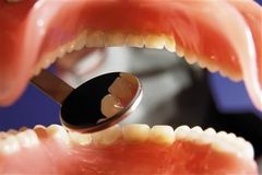 Zubní kaz má 80 procent lidí, ročně se jich vyvrtá 6 milionů