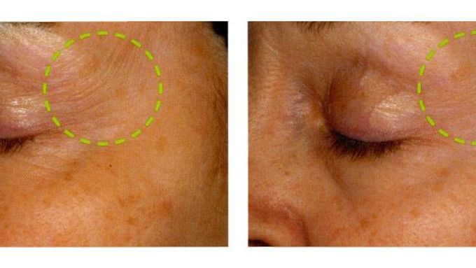 Pětašedesátiletá pacientka při klinickém testu dosáhla po dvanácti týdnech významného zjemnění pokožky na obličeji. Díky léku, který vznikl v důsledku výzkumu stárnutí rostlin.
