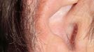 Hypertrichosis (excessive hairiness) of the ear rims Hypertrichosis (excessive hairiness) of the ear rims